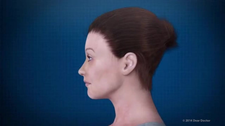 Consequences of Missing Teeth